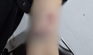 Korban menunjukkan luka memar pada lengannya usai alami KDRT. (dok: Akbar/katakaltim)